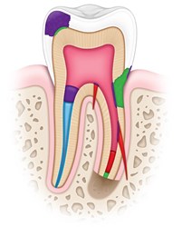 Picture for category Endo Materials
