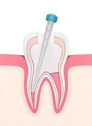 Picture for category Fiber Post
