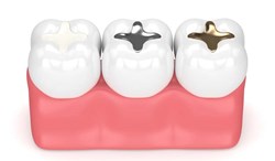 Picture for category Amalgam
