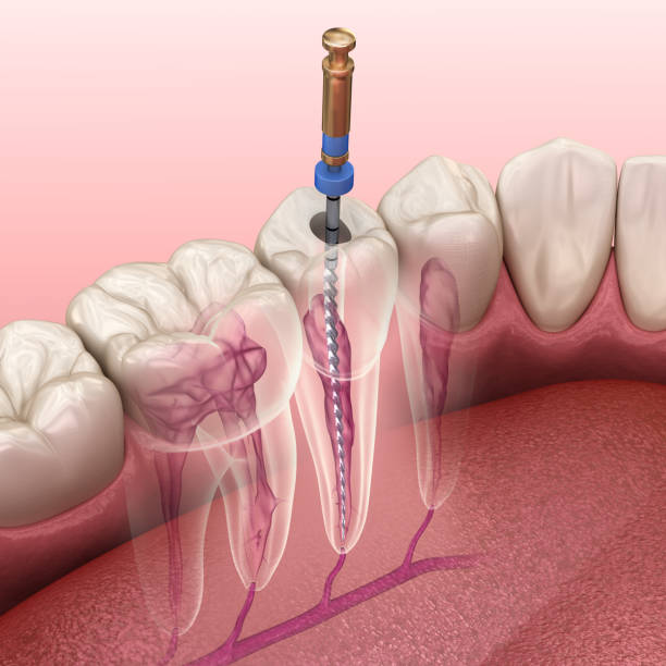 Picture for category Endodontics